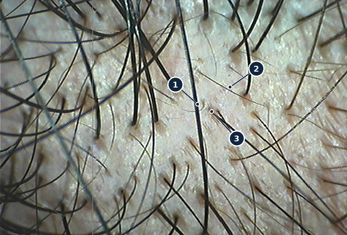 Tricoscopía real del cuero cabelludo: 1, pelo terminal grueso; 2, pelo miniaturizado fino; 3, unidad folicular con más de un pelo.